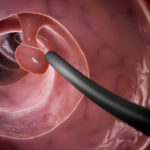 Pólipos uterinos: preguntas y respuestas