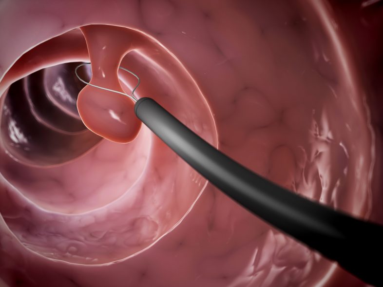 porque se producen los polipos uterinos