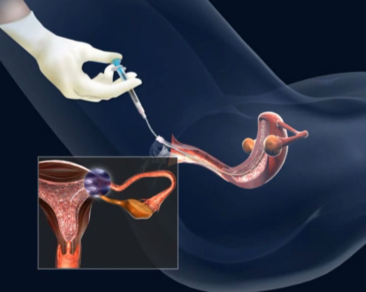 процедура введения спермы в матку фото 15