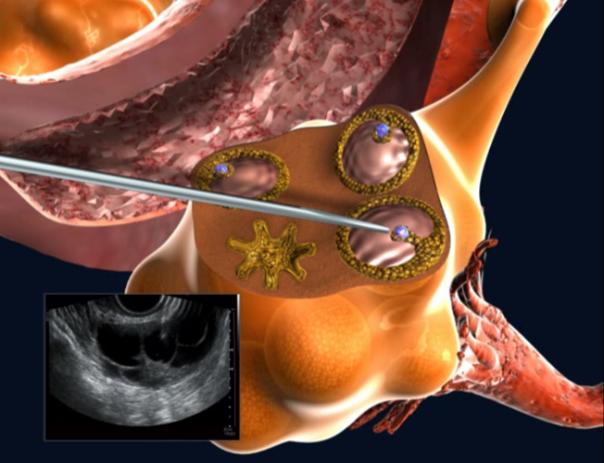 puncion folicular